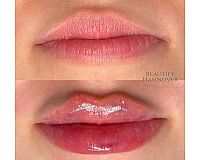 Lippenunterspritzung, Hyaluron, Russian Lips 1 ml 299€