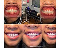 Zahnbleaching Zahnaufhellung und Zahn gems